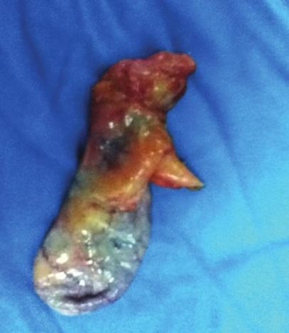 reported a similar case in a 72-year-old woman who presented with acute pancreatitis [4, 8, 9]. Another adult case was reported by Argawal et al.
