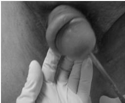 Uncircumcised Patient Phimosis Inability to retract foreskin due to excessive