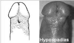 Other Considerations: Position of the Urethra Hypospadias Urethral meatus located towards ventral