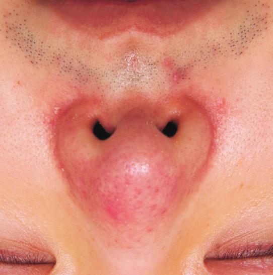 Nasal Rosacea and Pulsed-Type RF Tae Hwan Ahn and Sung Bin Cho Introduction Rosacea is a chronic inflammatory disorder of the facial and extrafacial skin that clinically appears as flushing and