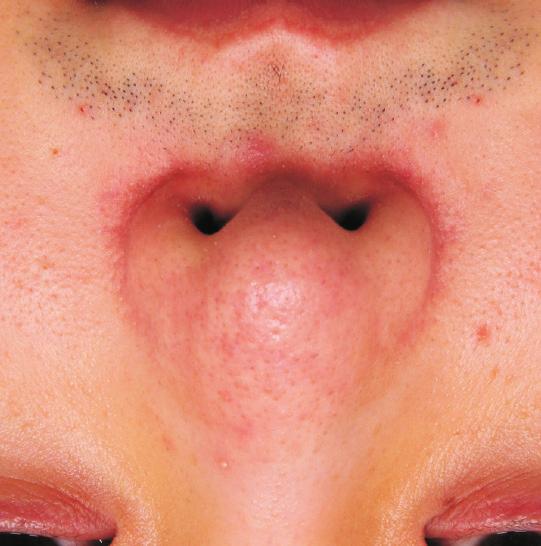 3 Compared with phymatous or mixed subtypes, erythematotelangiectatic rosacea localized to the nasal areas exhibits shorter disease duration and lower severity.