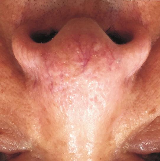 exhibited markedly telangiectatic lesions on a mildly phymatous nose (Fig. 2A).