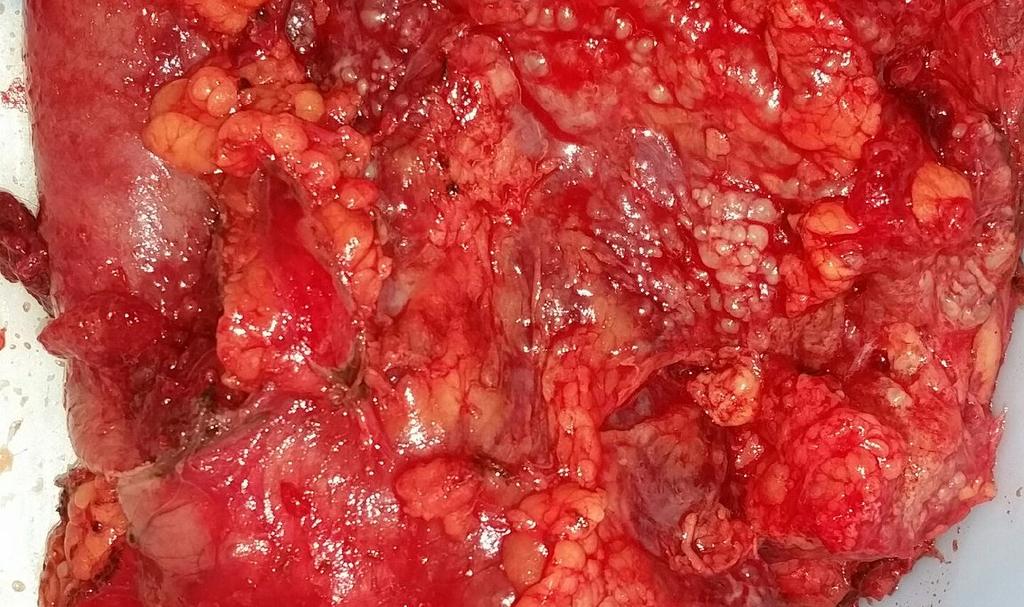 Transmural tumor 1/18 nodes involved Posterior bladder