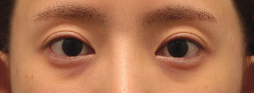 The design is composed of three incision lines, a lower eyelid incision, an upper eyelid incision, as well as an incision for VY advancement.