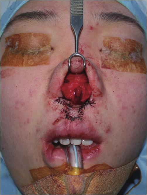 Vol. 42 / No. 6 / November 2015 In this study, a full thickness skin graft from the postauricular area was used to lengthen the short columella during secondary cleft nose repair in adult patients.