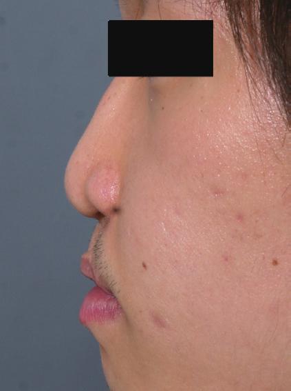 After open rhinoplasty, as all patients showed a severely short columella and suturing the columellar flap directly could lead to unsatisfying tip projection, we measured the extent of the columellar