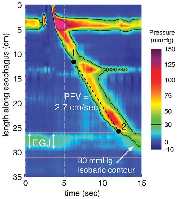 Kahrilas et al. Page 10 FIGURE 3. Derivation of the pressurization front velocity (PFV) from 30-mm Hg isobaric contour plots. The heavy black line delineates the pressure domain 30mm Hg.