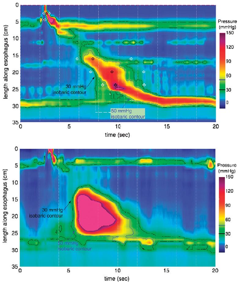 Kahrilas et al. Page 12 FIGURE 5. Differentiating a rapid PFV attributable to compartmentalized esophageal pressurization (top) from a rapidly propagated contraction (bottom).