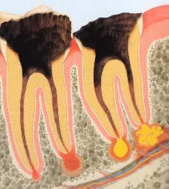 Some Reasons for Tooth Extraction * Carious exposure of pulp