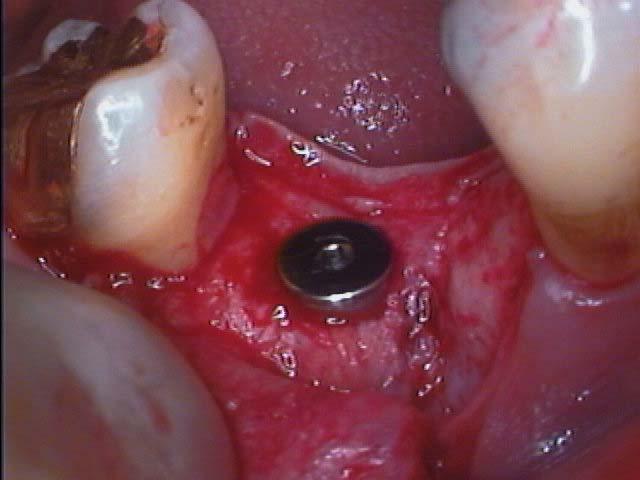 implantation of an abutment