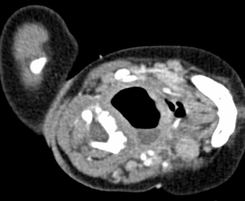 Recurrence on CT - 1.