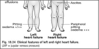 Right Heart Failure RV Hypertrophy