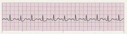11. Identify the following rhythm (lead II): Sinus rhythm with a wide QRS at 100 beats/min; ST-segment depression, inverted T waves 12.