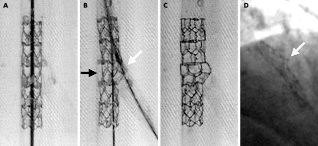 Final Kissing Ballooning () in 1- Stent Technique Pros Scaffolding of SB osnum (white arrow) Access to SB preserved Correct distal stent sizing OpNmizing proximal