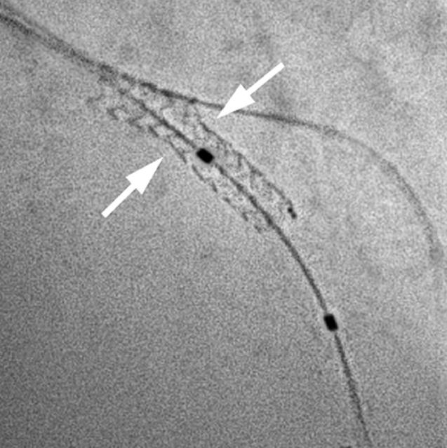 side- branch angioplasty Stent configuranon following