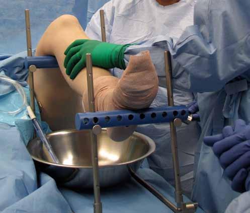 Tips and Tricks: The Russell Frame allows for excellent access to the leg for debridement and