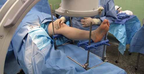 Tips and Tricks: With the leg in a stable position, the X-Ray Technologist adjusts the
