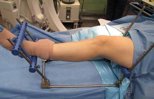 For example, the femoral Support Bar in this position helps reduce a distal femur fracture where the distal femur