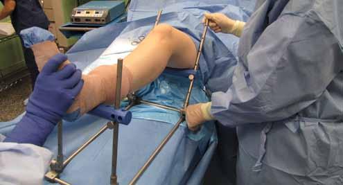 Semi-Extended Position The semi-extended position is the most common position and can be used for a number of different surgeries that may include: Supra-patellar tibial nailing Retrograde femoral