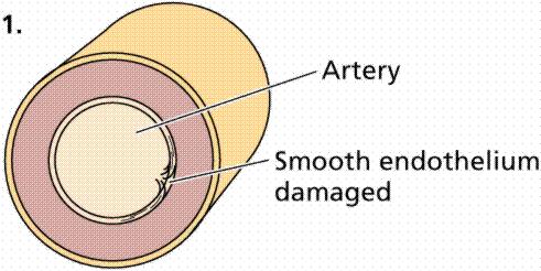 Atherosclerosis build up of plaque (hardened fat) on artery walls: