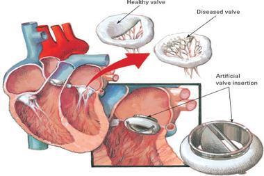 Heart Valves- Flap of tissue that prevents backward flow of blood AV Valves Tricuspid