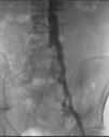 limiting claudication despite non-invasive therapy For proximal (Aorto-iliac disease), angioplasty can be first line therapy Vasc Med.