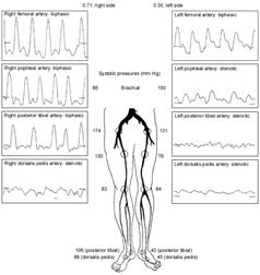 Pulse Volume Morphology Example: Left Leg Critical Limb Ischemia Ankle pressures: 45mmHg ( < 50 mmhg consistent with CLI) ABI: 0.30 ( < 0.40 consistent with CLI) Gerhard-Herman M et al. Vasc Med.