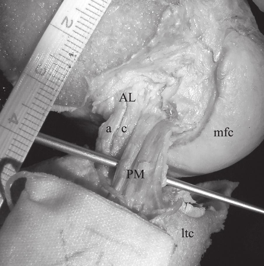 Posteromedial bundle of posterior cruciate ligament posteromedial bundle (PM); long longitudinal fascicle, obl oblique fascicle, ltc lateral tibial condyle, mfc medial femoral