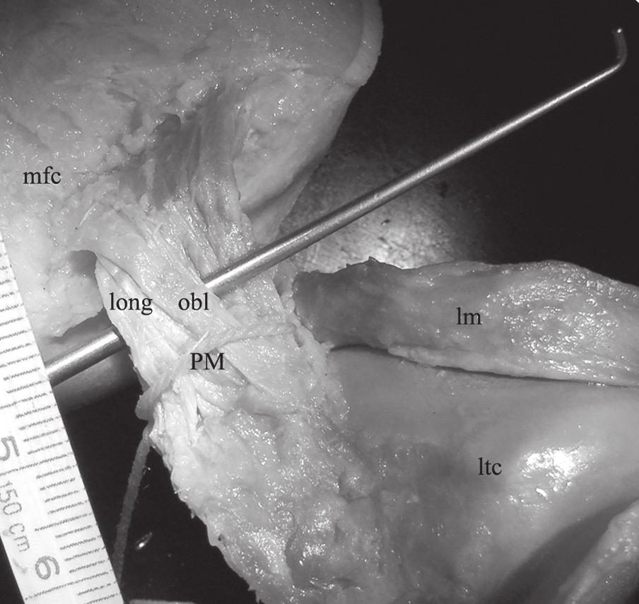 Anterolateral bundle of posterior cruciate ligament (PCL) anterolateral bundle (AL); a anterior fascicle, c central fascicle, PM posteromedial bundle of PCL, mfc medial femoral