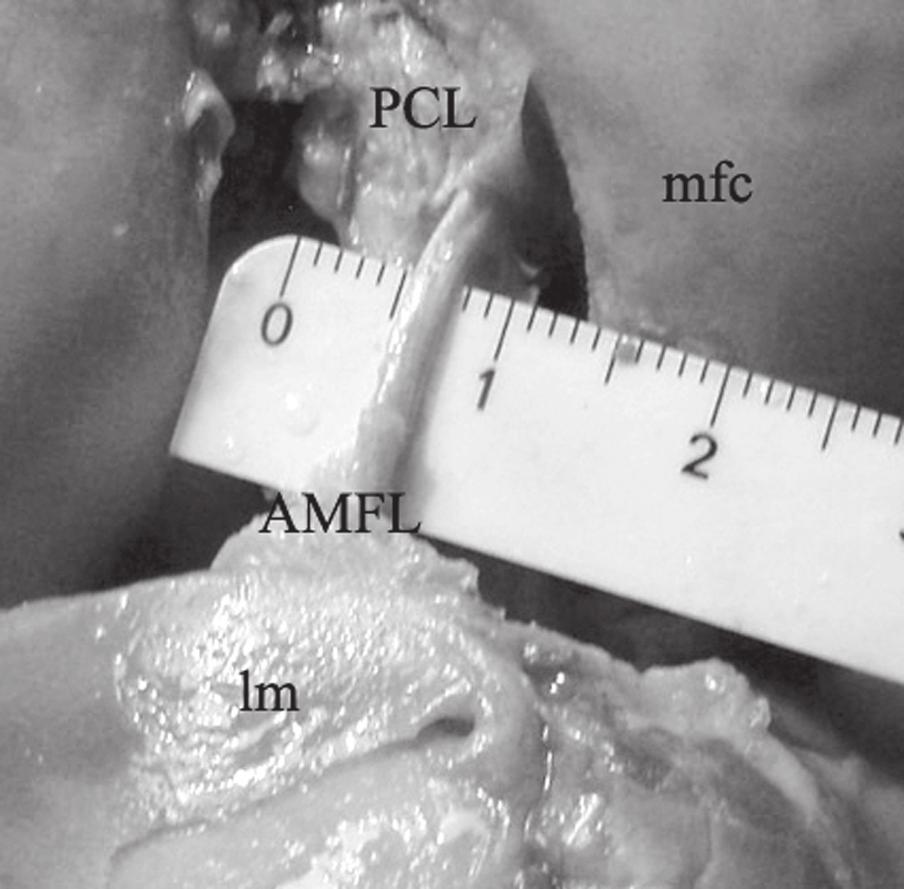 A. Chwaluk, B. Ciszek, Anatomy of the posterior cruciate ligament Figure 5. Anterior meniscofemoral ligament (AMFL); mfc medial femoral condyle, lm lateral meniscus; PCL posterior cruciate ligament.