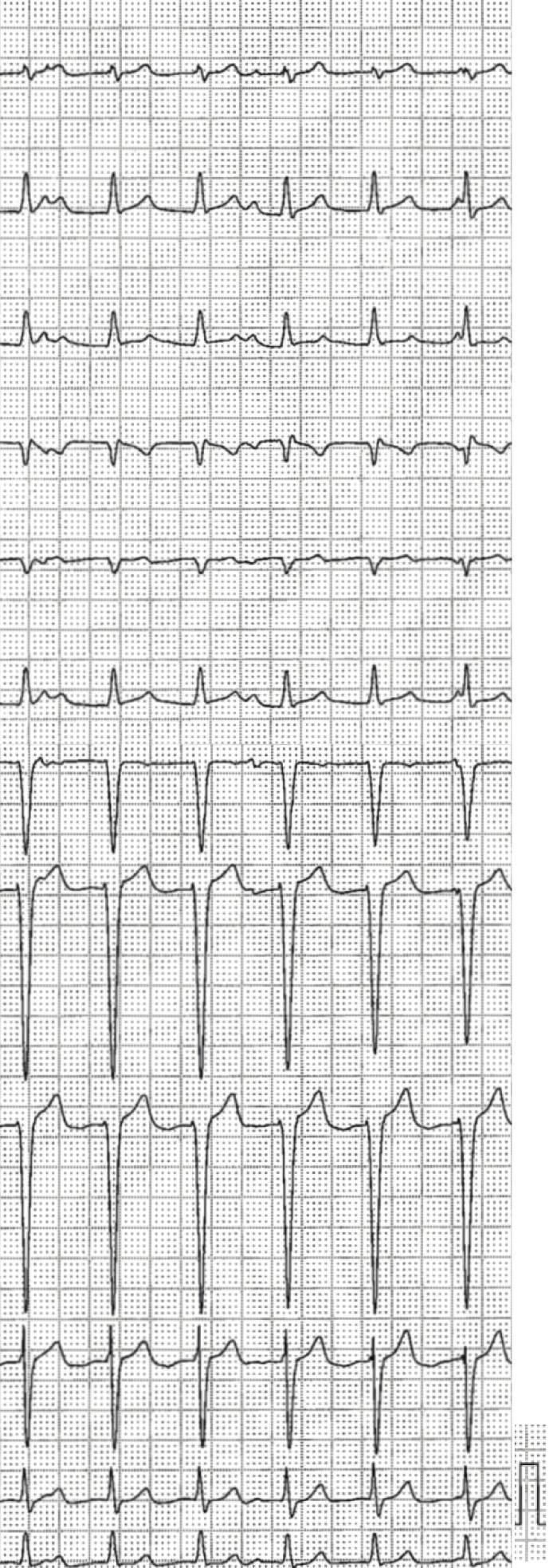 2 Figure 1: The baseline 12-lead electrocardiogram (ECG) in the supine position shows accelerated idioventricular rhythm (AVR) without atrioventricular conduction.