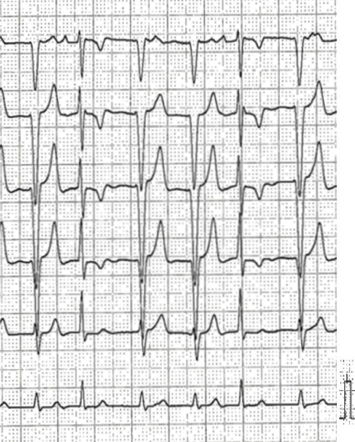 The patient was restored to sinus rhythm immediately, and tachycardia was not inducible at the end of the study.