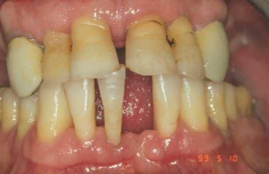 If teeth should be extracted ore got lost due to very severe