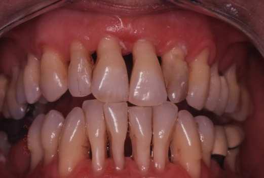 The periodontitis weakens the periodontal