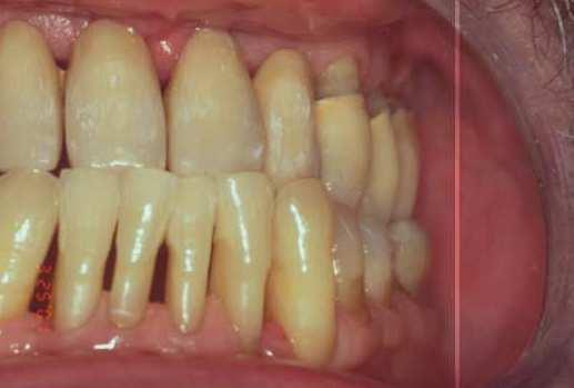 the remaining 50-60% of the periodontal