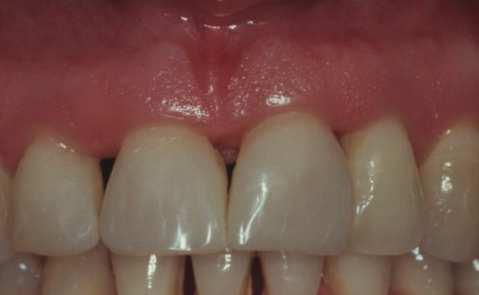 It is important that the proximal surfaces should be finished and