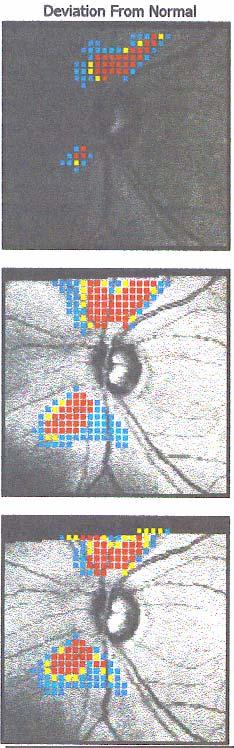 detect glaucoma