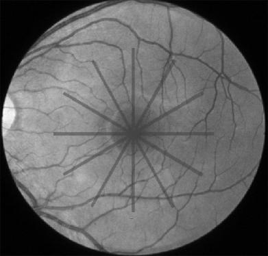 Macular retinal thickness on Stratus OCT Zeiss Stratus OCT 400 A-scan