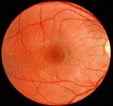 Retinal thickness mapping is not sensitive for detecting glaucoma because