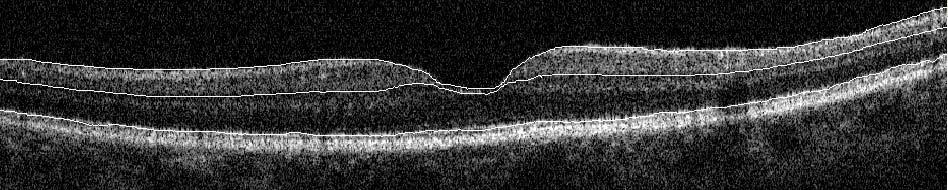Complex (GCC) Ganglion cells: Axons = nerve fiber layer Body = ganglion cell