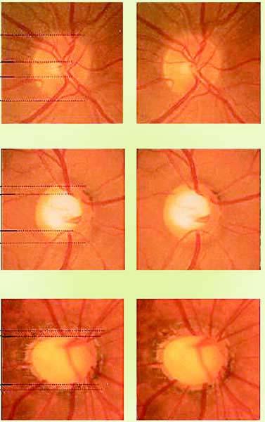 Optic disc change using Stereo disc photos is subjective and qualitative with only moderate intraobserver and interobserver reproducibility Azuara-Blanco A, Katz JL, Spaeth GL, et al.