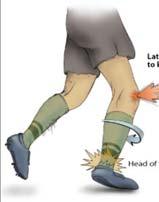 Clinical evaluation Mechanism usually external rotation and/or hyperdorsiflexion