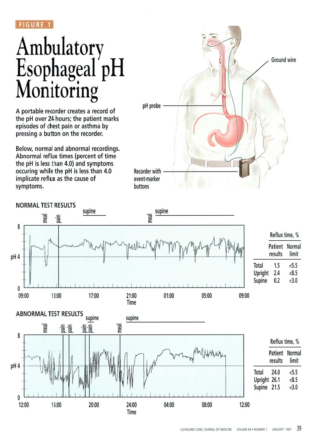 FIGURE 1 Ambulatory Esophageal ph Monitoring A portable recorder creates a record of the ph over 24 hours; the patient marks episodes of chest pain or asthma by pressing a button on the recorder.