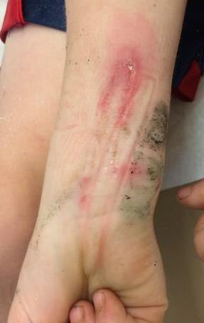 Pitfalls hort Arm cast/splint Cast padding gets wet causing skin maceration Pressure sore 2 nd to poor padding
