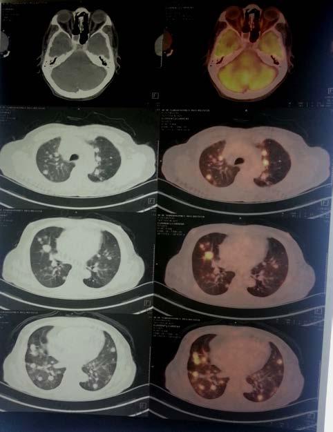 RECENT PET CT(May 16 FDG avid multiple