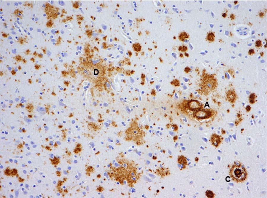 Aβ Deposits: Morphological Heterogeneity CP D, diffuse plaque; C,