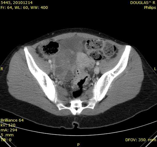 CT shows: Large multicystic right