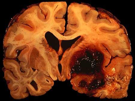 Intracranial Hemorrhage High Incidence o Accounts for 10-15% of all strokes 1,2,5 o 80,000 cases in US; 2 million WW 2,5 o Incidence doubles for African- Americans and Asians 1,2,3 High