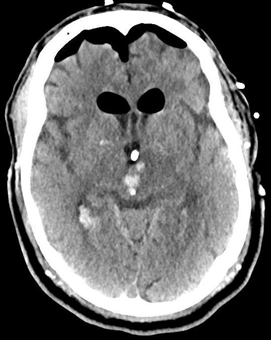 of extremities CT: lt thalamic ICH w IVH