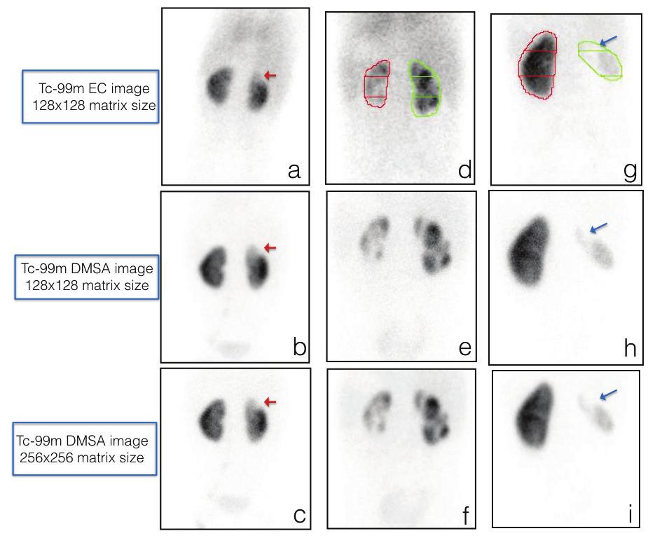 Table 1: Comparison of detection of scarring in the image of two matrix sizes of Tc-99m DMSA No of scars DMSA 128 128 DMSA 256 256 P value* 50% >50% 50% >50% Upper segment 20 28 21 27 0.